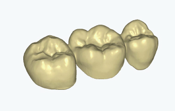 Model STL korony stomatologicznej