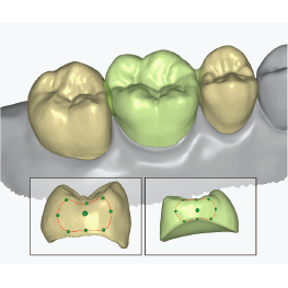 Projektowanie korony zęba w programie CAD