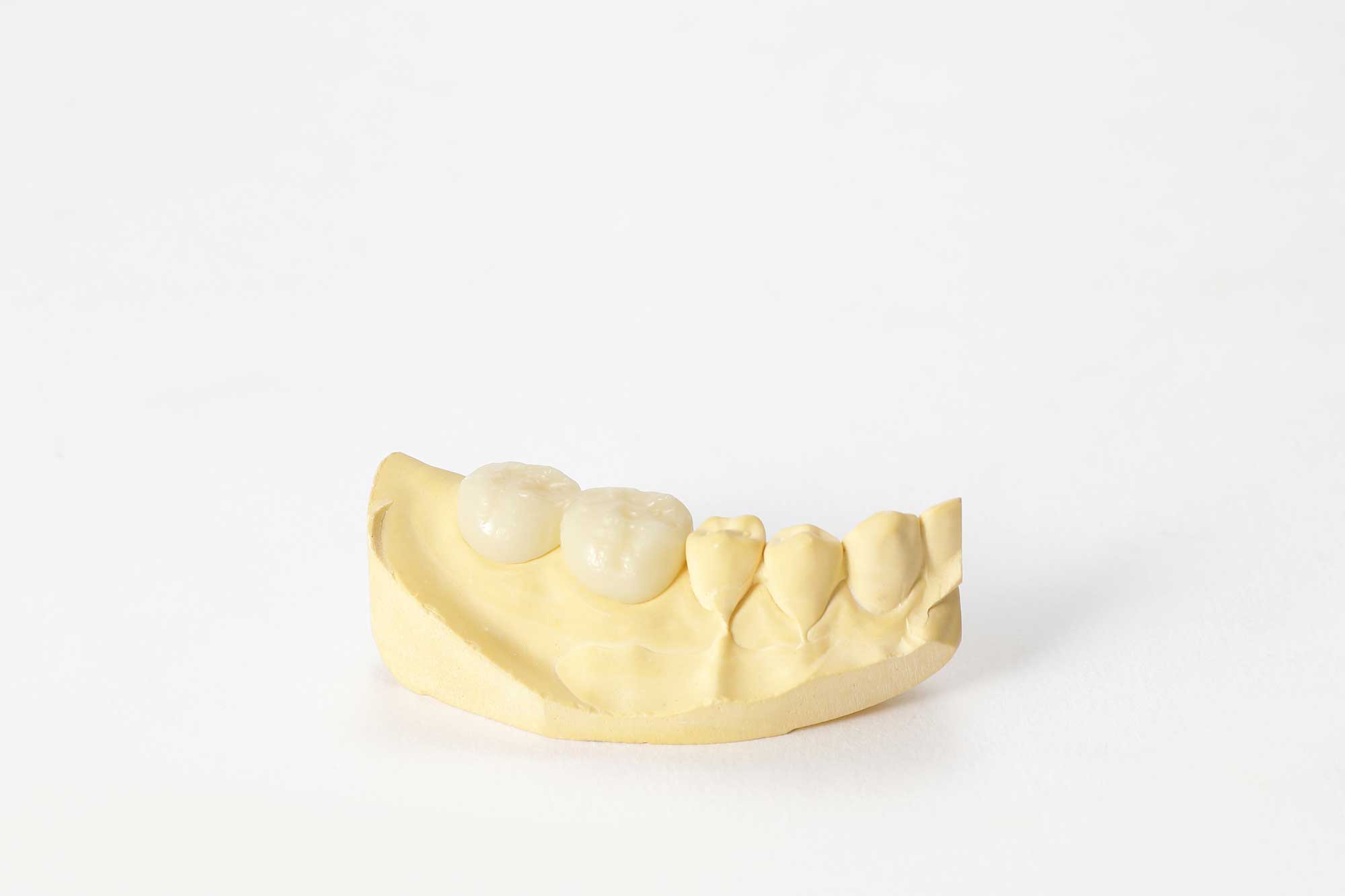 Tymczasowy most stomatologiczny nałożony na wycinkowy model zębów
