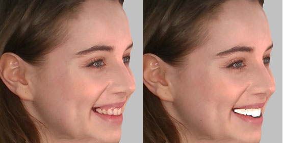 Modele 3D twarzy kobiety bez i z nowo zaprojektowanym uśmiechem 