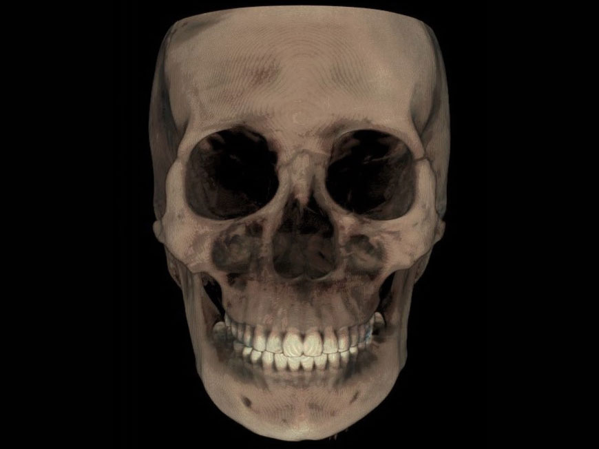 Tomografia twarzoczaszki w 3D