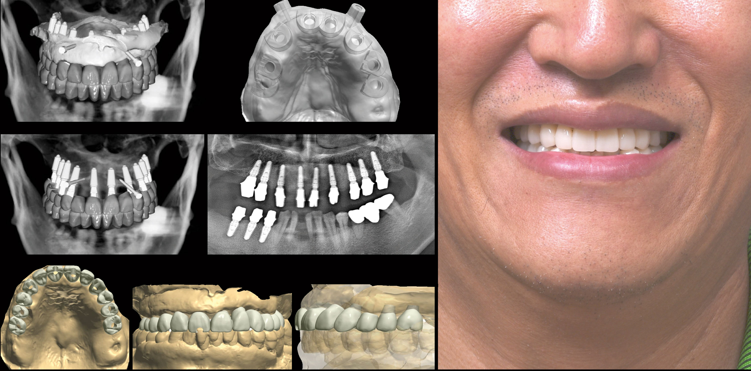 Uśmiech pacjenta po zabiegu implantologicznym, panoramy z zaplanowanymi implantami, szablon chirurgiczny