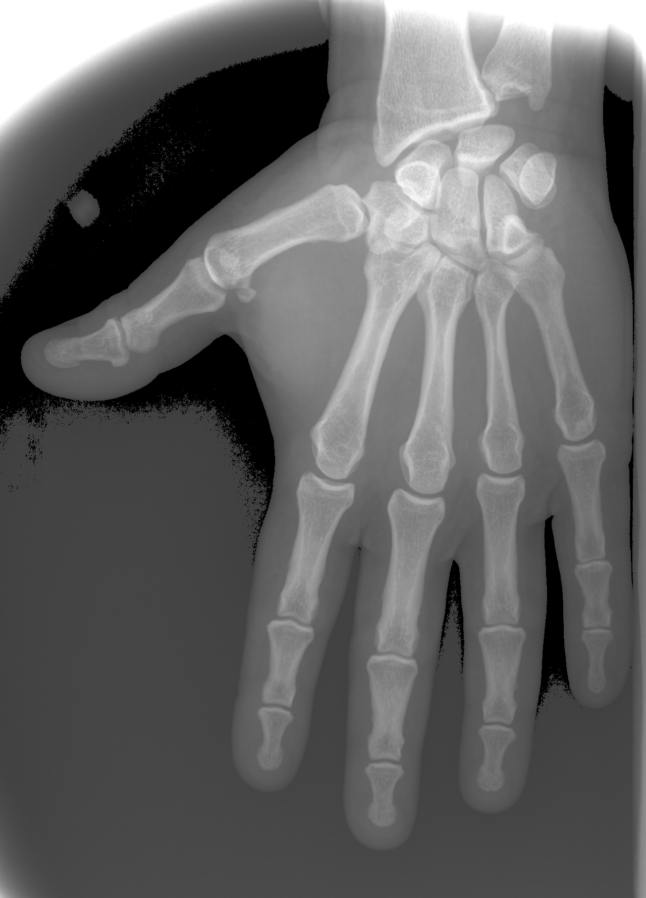 Prześwietlenie ręki wykonany rentgenem punktowym Rextar-X